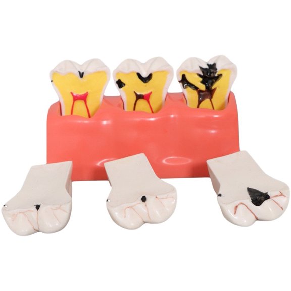 Yvsxxv Red Resin Caries Process Display Science Models 1Pc