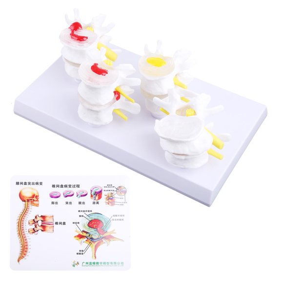 Ywmsfl 1 Set Human Lumbar Lesion Spine Statue Display Model Medical Teaching Learning f