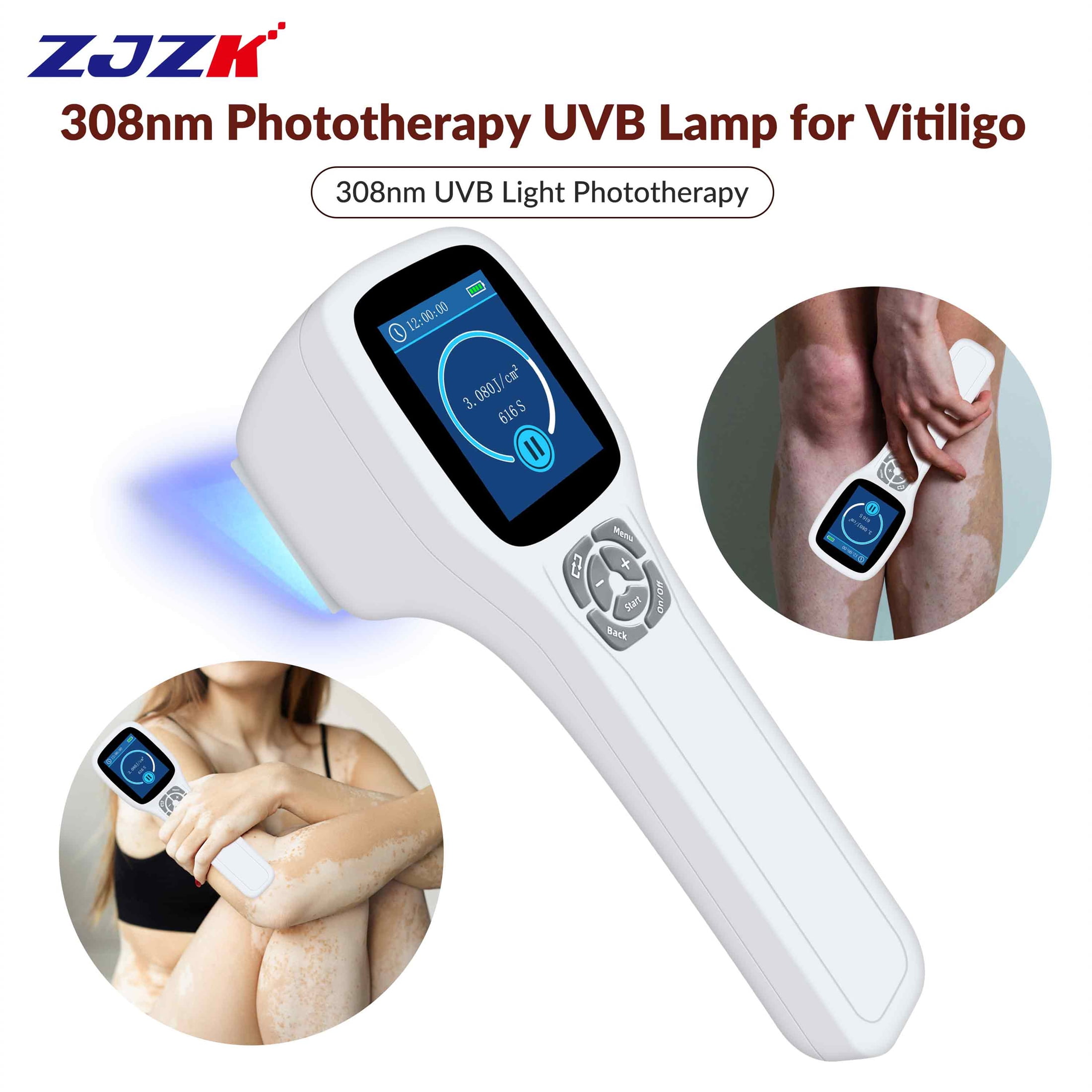 ZJZK Excimer Phototherapy Device 308nm UVB Light Phototherapy at Home