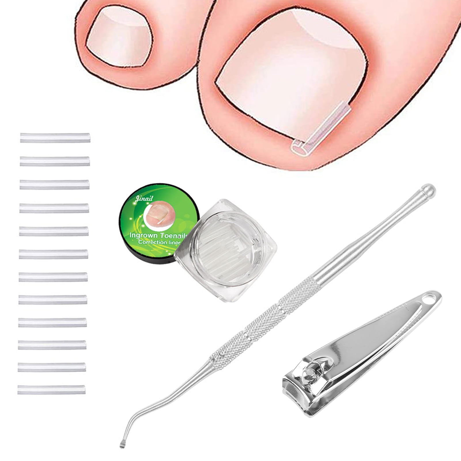 ZPAQI Ingrown Toenail Correction Treatment Pack Professional Ingrown Toenail Corrector